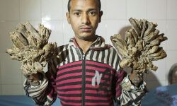 മരമനുഷ്യന്റെ കൈയിലും കാലിലും കൂടുതല്‍ വേരുകള്‍ വളരുന്നു; പുതിയ ശസ്ത്രക്രിയക്കൊരുങ്ങി ഡോക്ടര്‍മാര്‍