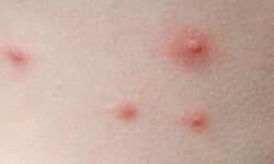 ചിക്കന്‍പോക്സ് പടരുന്നു: ജാഗ്രതാ നിര്‍ദേശവുമായി ആരോഗ്യവകുപ്പ്