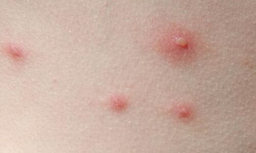 ചിക്കന്‍പോക്സ് പടരുന്നു: ജാഗ്രതാ നിര്‍ദേശവുമായി ആരോഗ്യവകുപ്പ്