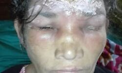 എടവണ്ണയില്‍ കര്‍ഷകയ്ക്ക് സൂര്യാഘാതമേറ്റു