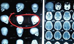 തൊടുപുഴയിലെ ക്രൂരത: ഏഴു വയസുകാരന്റെ ആരോഗ്യനിലയില്‍ പുരോഗതിയില്ല;  തലച്ചോറിന്റെ പ്രവര്‍ത്തനം നിലച്ചു