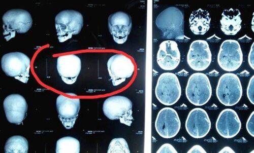തൊടുപുഴയിലെ ക്രൂരത: ഏഴു വയസുകാരന്റെ ആരോഗ്യനിലയില്‍ പുരോഗതിയില്ല;  തലച്ചോറിന്റെ പ്രവര്‍ത്തനം നിലച്ചു