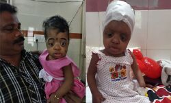 തലച്ചോറിന് വളരാനാകാത്തവിധം തലയോട്ടി കൂടിച്ചേരല്‍;  എസ്എടിയില്‍ രണ്ടുവയസുകാരിക്ക് അപൂര്‍വ ശസ്ത്രക്രിയ