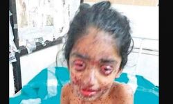 സോനയുടെ ചികില്‍സ ഏറ്റെടുത്തതായി ആരോഗ്യമന്ത്രി