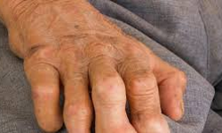 മൂന്നുപേരില് കുഷ്ഠരോഗം സ്ഥിരീകരിച്ചു മൂന്നുപേരില് കുഷ്ഠരോഗം സ്ഥിരീകരിച്ചു