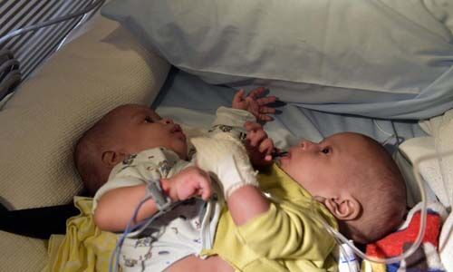 ശസ്ത്രക്രിയ: സയാമീസ് ഇരട്ടകളായ മുഹമ്മദിനെയും ഫുദൈലിനെയും റിയാദിലെത്തിച്ചു