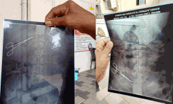 ശസ്ത്രക്രിയക്കിടെ കത്രിക വയറില്‍; ഡോക്ടര്‍ക്കെതിരെ കേസ്