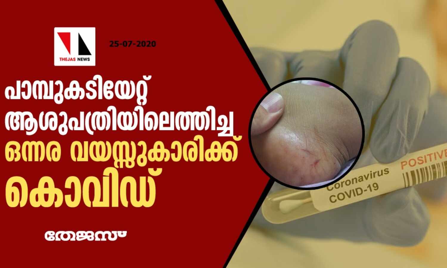 പാമ്പുകടിയേറ്റ് ആശുപത്രിയിലെത്തിച്ച ഒന്നര വയസ്സുകാരിക്ക് കൊവിഡ് പാമ്പുകടിയേറ്റ് ആശുപത്രിയിലെത്തിച്ച ഒന്നര വയസ്സുകാരിക്ക് കൊവിഡ്