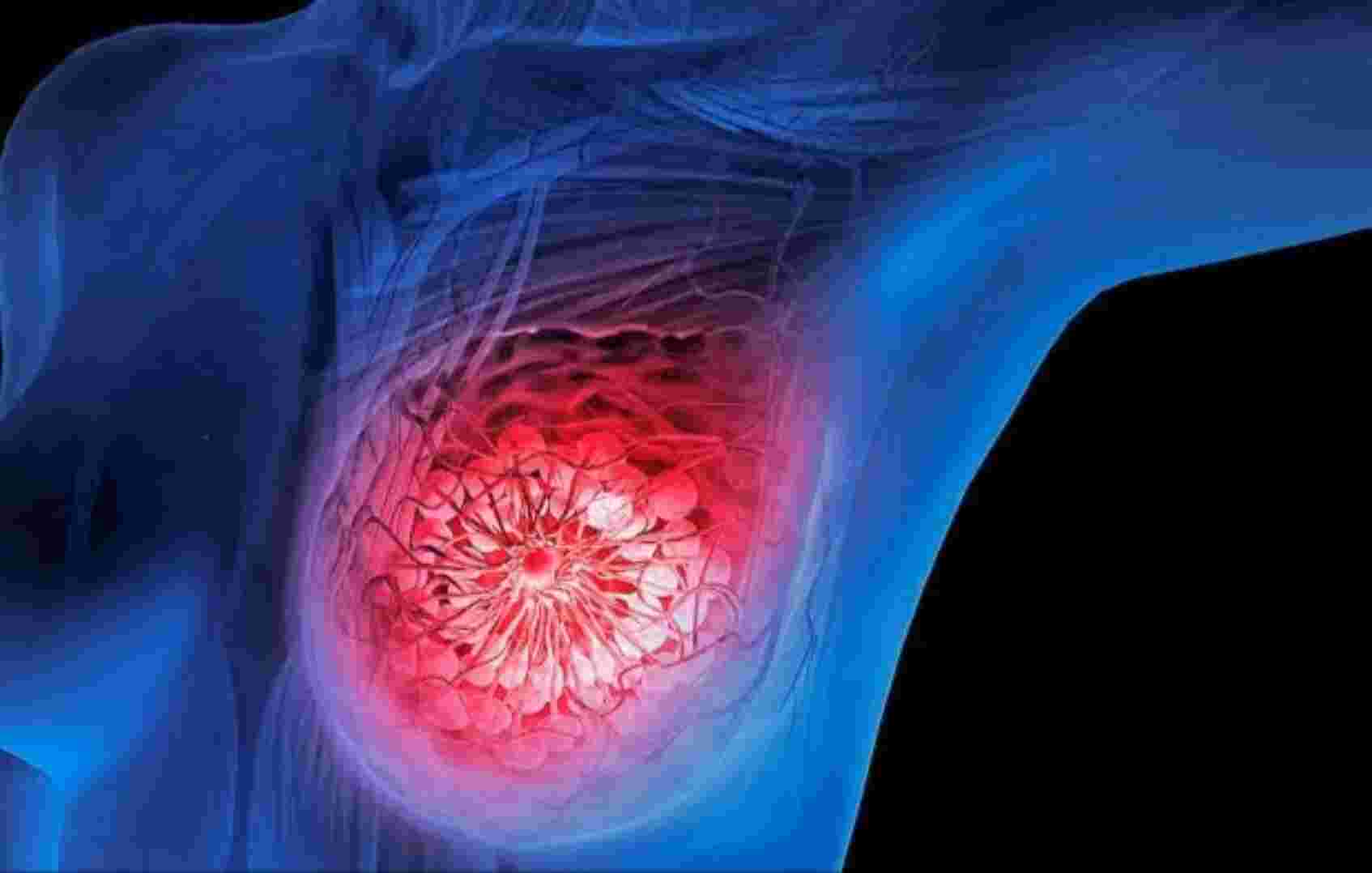 ക്യാൻസർ രജിസ്ട്രി 2017: കൂടുതൽ സ്തനാർബുദ കേസുകൾ ക്യാൻസർ രജിസ്ട്രി 2017: കൂടുതൽ സ്തനാർബുദ കേസുകൾ