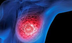 ക്യാൻസർ രജിസ്ട്രി 2017: കൂടുതൽ സ്തനാർബുദ കേസുകൾ