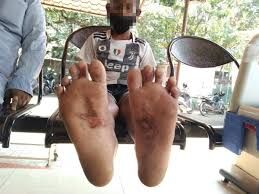 എട്ടു വയസ്സുകാരനെ സഹോദരി ഭര്‍ത്താവ് കാലില്‍ പൊള്ളിച്ചു; യുവാവ് അറസ്റ്റില്‍