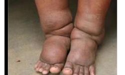 എറണാകുളം ജില്ല മന്തുരോഗ വിമുക്തമാകുന്നു