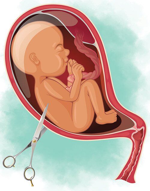 യുഎസിലെ അരാക്കന്‍ സംസ്ഥാനം ഗര്‍ഭഛിദ്രം നിരോധിച്ച് നിയമം പാസാക്കി