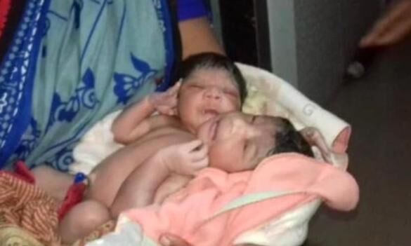 ഒഡീഷയില് മൂന്നു കൈകളുമയി സയാമീസ് ഇരട്ടകള് പിറന്നു ഒഡീഷയില് മൂന്നു കൈകളുമയി സയാമീസ് ഇരട്ടകള് പിറന്നു