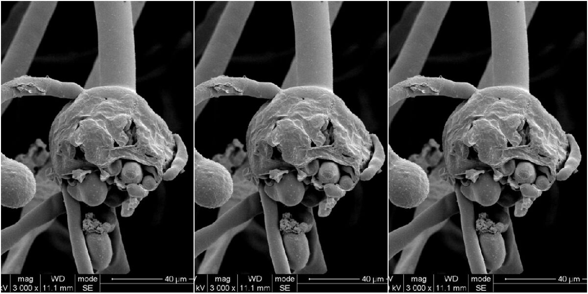 കോഴിക്കോട് മെഡിക്കല്‍ കോളജില്‍ മരിച്ച രോഗിക്ക് ബ്ലാക്ക് ഫംഗസ് സ്ഥിരീകരിച്ചു
