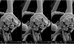 കോഴിക്കോട് മെഡിക്കല്‍ കോളജില്‍ മരിച്ച രോഗിക്ക് ബ്ലാക്ക് ഫംഗസ് സ്ഥിരീകരിച്ചു
