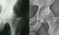 ഡല്‍ഹിയില്‍ മൂന്ന് കൊവിഡ് രോഗമുക്തരില്‍ ഗുരുതരമായ എല്ല് രോഗം കണ്ടെത്തി