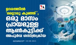 ഉദരത്തില്‍ മറ്റൊരു കുഞ്ഞ്; ഒരു മാസം പ്രായമുള്ള ആണ്‍കുട്ടിക്ക് അപൂര്‍വ ശസ്ത്രക്രിയ