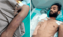 പോലിസ് കസ്റ്റഡിയില്‍ യുവാവിന് ക്രൂരമര്‍ദനം; വലതുകൈ മുറിച്ചുമാറ്റി