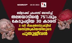ബ്ലാക്ക് ഫംഗസ് ബാധിച്ച് തലയോടിന്റെ 75 % വും കേടുപറ്റിയ 30 കാരന് 3 ഡി റീകണ്‍സ്ട്രക്റ്റീവ് ശസ്ത്രക്രിയയിലൂടെ പുതുജീവന്‍