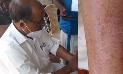 പുനലൂരില്‍ നഗരസഭാംഗത്തിന് സൂര്യാതപമേറ്റു