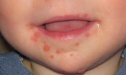 ഹാന്ഡ് ഫൂട്ട് മൗത്ത് ഡിസീസ്: ആശങ്ക വേണ്ട, രോഗത്തെ അറിയാം ഹാന്ഡ് ഫൂട്ട് മൗത്ത് ഡിസീസ്: ആശങ്ക വേണ്ട, രോഗത്തെ അറിയാം