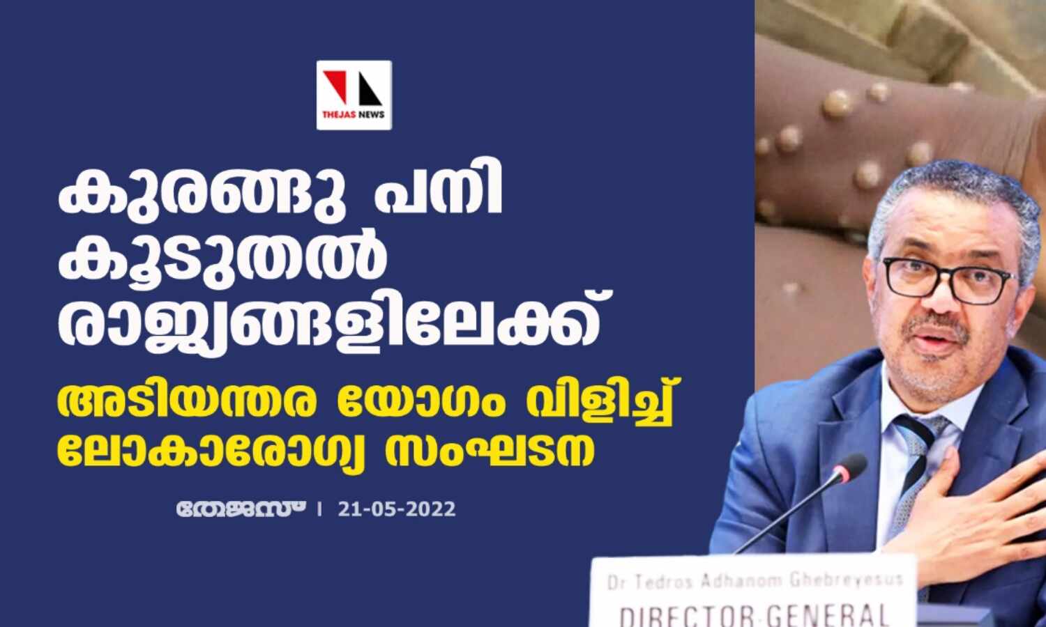 കുരങ്ങു പനി കൂടുതല് രാജ്യങ്ങളിലേക്ക്;അടിയന്തര യോഗം വിളിച്ച് ലോകാരോഗ്യ സംഘടന കുരങ്ങു പനി കൂടുതല് രാജ്യങ്ങളിലേക്ക്;അടിയന്തര യോഗം വിളിച്ച് ലോകാരോഗ്യ സംഘടന