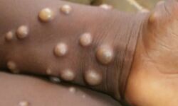 കുരങ്ങുപനിക്കെതിരേ സംസ്ഥാനത്ത് ജാഗ്രത: മന്ത്രി വീണാ ജോര്‍ജ്