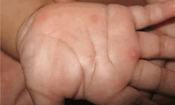 കല്ലാര് എല് പി സ്ക്കൂളിലെ 20 കുട്ടികള്ക്ക് തക്കാളിപ്പനി കല്ലാര് എല് പി സ്ക്കൂളിലെ 20 കുട്ടികള്ക്ക് തക്കാളിപ്പനി