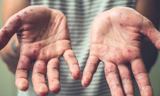 എന്താണ് ഹാന്ഡ്ഫൂട്ട്മൗത്ത് ഡിസീസ്? എന്താണ് ഹാന്ഡ്ഫൂട്ട്മൗത്ത് ഡിസീസ്?