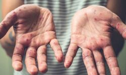 എന്താണ് ഹാന്‍ഡ്ഫൂട്ട്മൗത്ത് ഡിസീസ്?