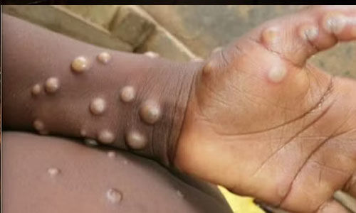 കേരളത്തിലും കുരങ്ങ് പനിയെന്ന് സംശയം;സാംപിളുകള് പരിശോധനക്ക് അയച്ചു കേരളത്തിലും കുരങ്ങ് പനിയെന്ന് സംശയം;സാംപിളുകള് പരിശോധനക്ക് അയച്ചു