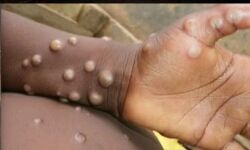 കേരളത്തിലും കുരങ്ങ് പനിയെന്ന് സംശയം;സാംപിളുകള്‍ പരിശോധനക്ക് അയച്ചു