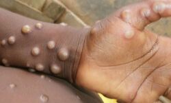 മങ്കിപോക്സ്: പൊതുജനാരോഗ്യ നടപടികള് സ്വീകരിക്കുന്നതിനായി കേന്ദ്രസംഘം കേരളത്തിലേക്ക് മങ്കിപോക്സ്: പൊതുജനാരോഗ്യ നടപടികള് സ്വീകരിക്കുന്നതിനായി കേന്ദ്രസംഘം കേരളത്തിലേക്ക്