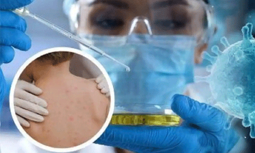 മങ്കിപോക്സ്: കേന്ദ്ര സംഘം ഇന്ന് കേരളത്തിലെത്തും മങ്കിപോക്സ്: കേന്ദ്ര സംഘം ഇന്ന് കേരളത്തിലെത്തും