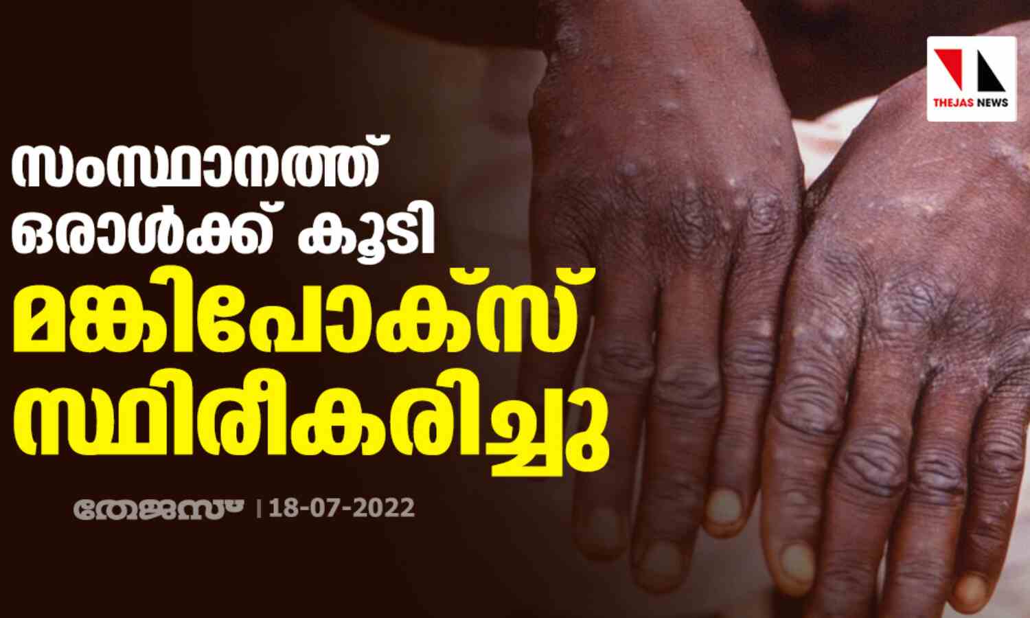 സംസ്ഥാനത്ത് ഒരാള്‍ക്ക് കൂടി മങ്കിപോക്‌സ് സ്ഥിരീകരിച്ചു