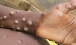 മങ്കി പോക്സ് ഐസൊലേഷനും ചികിത്സയ്ക്കുമുള്ള എസ്.ഒ.പി. പുറത്തിറക്കി മങ്കി പോക്സ് ഐസൊലേഷനും ചികിത്സയ്ക്കുമുള്ള എസ്.ഒ.പി. പുറത്തിറക്കി