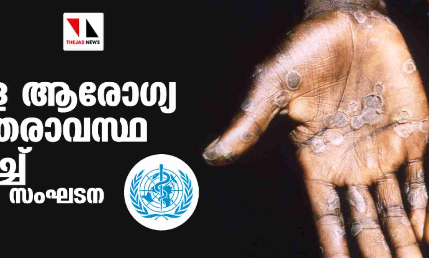 മങ്കിപോക്സ്: ആഗോള ആരോഗ്യ അടിയന്തരാവസ്ഥ പ്രഖ്യാപിച്ച് ലോകാരോഗ്യ സംഘടന മങ്കിപോക്സ്: ആഗോള ആരോഗ്യ അടിയന്തരാവസ്ഥ പ്രഖ്യാപിച്ച് ലോകാരോഗ്യ സംഘടന