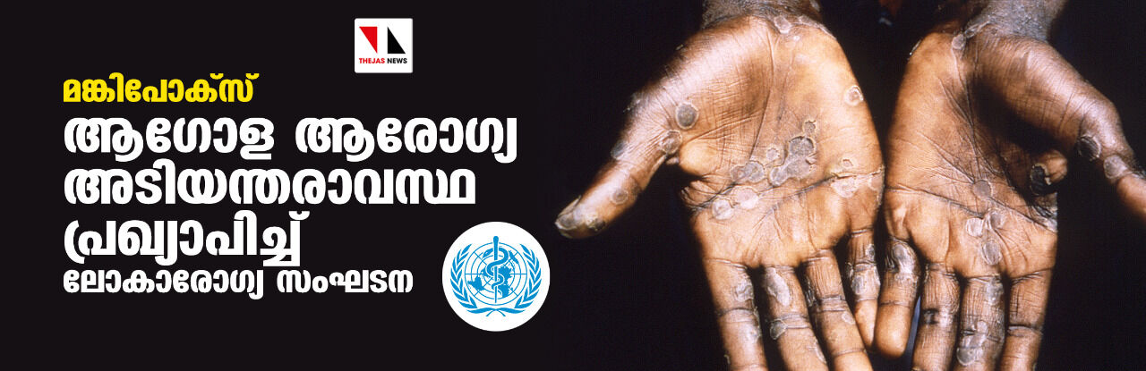 മങ്കിപോക്സ്: ആഗോള ആരോഗ്യ അടിയന്തരാവസ്ഥ പ്രഖ്യാപിച്ച് ലോകാരോഗ്യ സംഘടന മങ്കിപോക്സ്: ആഗോള ആരോഗ്യ അടിയന്തരാവസ്ഥ പ്രഖ്യാപിച്ച് ലോകാരോഗ്യ സംഘടന