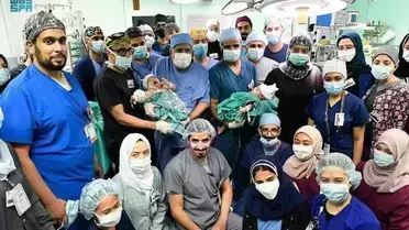 സൗദി ഡോക്ടര്‍മാരുടെ സംഘം യെമനില്‍നിന്നുള്ള സയാമീസ് ഇരട്ടകളെ വിജയകരമായി വേര്‍പെടുത്തി