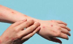 മങ്കിപോക്സ് ലക്ഷണം; മലപ്പുറം സ്വദേശിയെ മെഡിക്കൽ കോളജിൽ പ്രവേശിപ്പിച്ചു മങ്കിപോക്സ് ലക്ഷണം; മലപ്പുറം സ്വദേശിയെ മെഡിക്കൽ കോളജിൽ പ്രവേശിപ്പിച്ചു