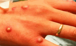 മങ്കി പോക്‌സ് : സംസ്ഥാന ആരോഗ്യ വകുപ്പ് ഉന്നതതല വിദഗ്ധ സംഘം തൃശൂരില്‍ പരിശോധന നടത്തി