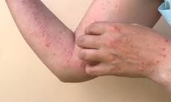 കുരങ്ങുപനിയെന്ന് സംശയം; കാസര്‍കോട് ഒരാള്‍ ആശുപത്രിയില്‍, 17 പേര്‍ നിരീക്ഷണത്തില്‍