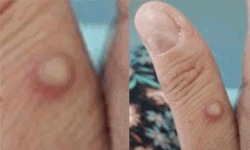 സംസ്ഥാനത്ത് വീണ്ടും മങ്കി പോക്‌സ് സ്ഥിരീകരിച്ചു