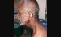 തെരുവ് നായയുടെ കടിയേറ്റ് മൂന്ന് വയസ്സുകാരനും ഗൃഹനാഥനും പരിക്ക്