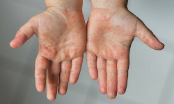 അഞ്ചാംപനി: നാദാപുരത്ത് ആകെ 23 കേസുകൾ അഞ്ചാംപനി: നാദാപുരത്ത് ആകെ 23 കേസുകൾ