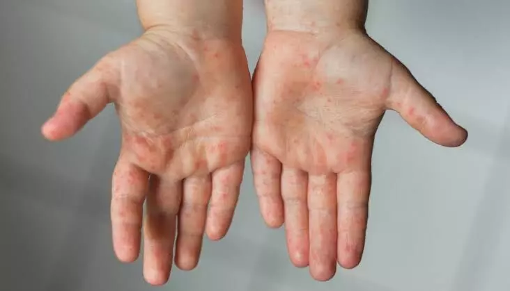 നാദാപുരത്ത് അഞ്ചാംപനി: ആറ് പുതിയ കേസുകൾ കൂടി റിപ്പോർട്ട് ചെയ്തു