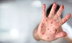 അഞ്ചാംപനി: നാദാപുരത്ത് മൂന്ന് കേസുകൾ റിപ്പോർട്ട് ചെയ്തു