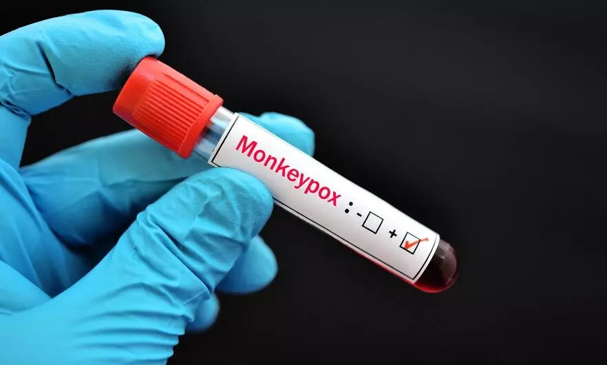 സൗദിയില്‍ നിന്ന് പാകിസ്തിലേക്ക് മടങ്ങിയെത്തിയ ഒരാള്‍ക്ക് കുരങ്ങുപനി സ്ഥിരീകരിച്ചു