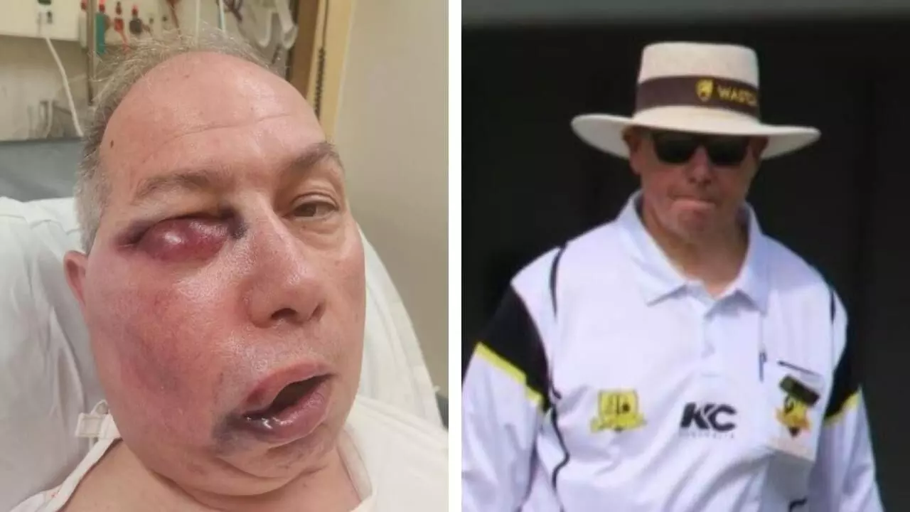 സ്ട്രെയ്റ്റ് ഡ്രൈവില് പന്ത് മുഖത്തടിച്ചു; അംപയര് ടോണി ഡെ നൊബ്രെഗയ്ക്ക് ഗുരുതര പരിക്ക് സ്ട്രെയ്റ്റ് ഡ്രൈവില് പന്ത് മുഖത്തടിച്ചു; അംപയര് ടോണി ഡെ നൊബ്രെഗയ്ക്ക് ഗുരുതര പരിക്ക്